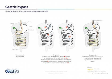 Figuur 1: De Gastric Bypass operatie, volgens de Roux-en-Y methode, in het kort Figuur 1: De Gastric Bypass operatie, volgens de Roux-en-Y methode, in het kort