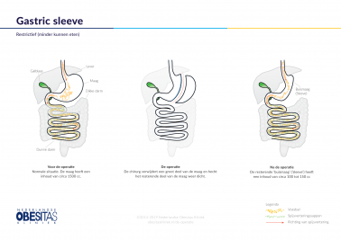 Figuur 1: Gastric Sleeve